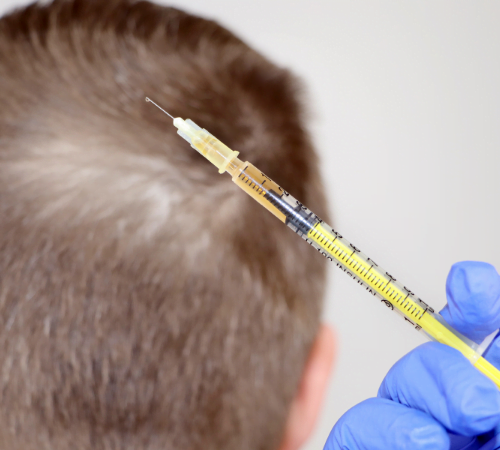 Hair Mesotherapy