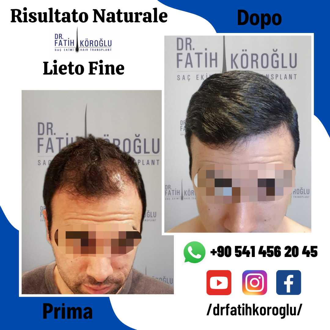 Trapianto di capelli | FUE Zaffiro | Da € 1500 | Follicoli Massimi