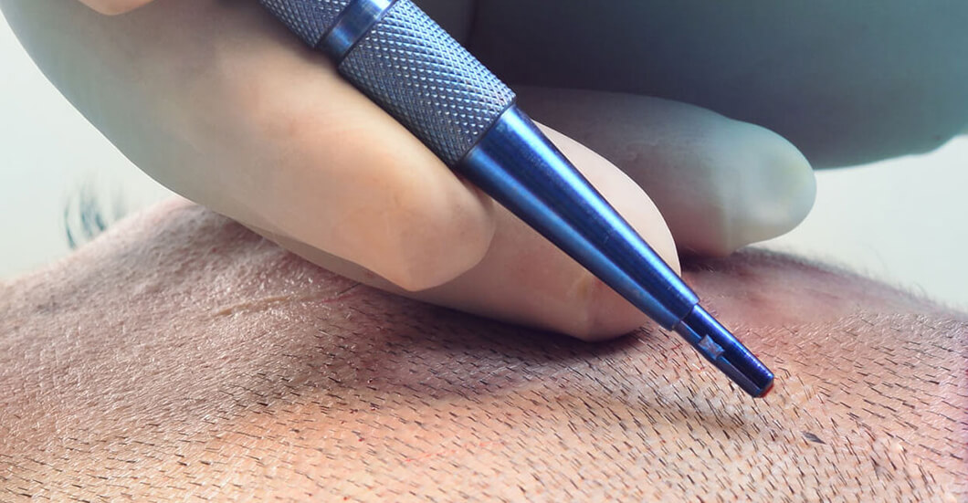 Trasplante Capilar en Estambul: Precios y Técnica FUE Zafiro